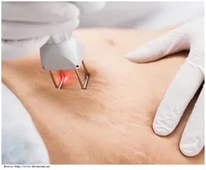 Stretch Mark Treatment in Gurgaon | Profrea Guide