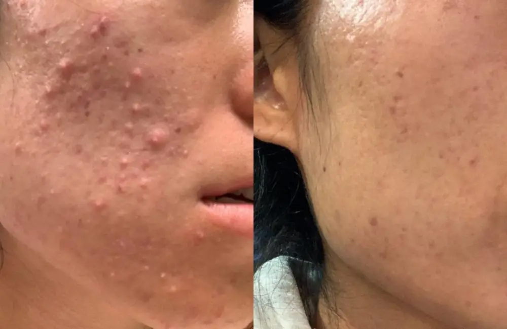 hydrafacials (1)